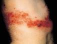 Management of Herpes Zoster (Shingles) and Postherpetic Neuralgia ...