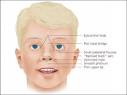 Fetal Alcohol Spectrum Disorders - July 15, 2005 - American Family ...