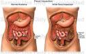 Fecal Impaction - Medical Illustration, Human Anatomy Drawing ...