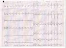 <b>Romano</b>-<b>Ward Syndrome</b> - Case