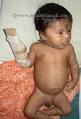 <b>Congenital Hypothyroidism</b> - A