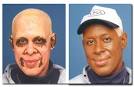 Michael Jacksons Skin