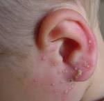 <b>Folliculitis</b> Definition