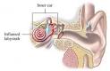 Labyrinthitis — UVA Health Home