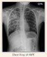 What is High Altitude Pulmonary Edema (
