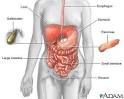 DIVERTICULITIS