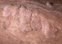 Just How Do Genital Warts Be Cured « About Genital Warts