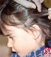hair lice FACTS of lice: