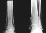 What You Don't Know About Bone Density