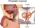 Natural Cures for Prostate Cancer That Get Powerful Results