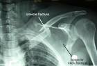 <b>Shoulder Fractures</b> and