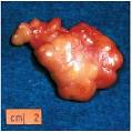 Tumor - body, process, type, characteristics, cells, surface, part ...