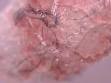 Morgellons Disease Pictures Images