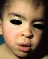 depressed nasal bridge,