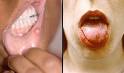 MouthUlcers1.gif