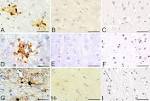 <b>Lyme neuroborreliosis</b>.