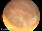 <b>Pars planitis</b>