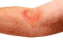 Atopic Dermatitis (Eczema) Basics Handout - Doctor recommended review