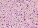 Figura 2. <b>Liposarcoma mixoide</b>.
