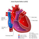 Atrial <b>Septal</b> (AS) <b>Heart Defects</b>, Symptoms & Treatment in Children
