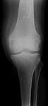 Benign Lytic Lesions and Bone Tumours
