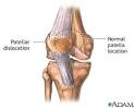<b>Patellar dislocation</b>