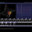 MR Cardiac 4D <b>Ventricular Function</b>