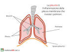 pleurite pronunciation
