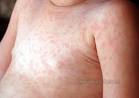 Roseola Rash - Pictures, Treatment, Symptoms, Causes, Contagious