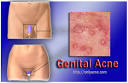 Genital acne treatment | onlyacne.