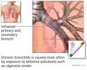 Chronic Bronchitis | Nursing Crib