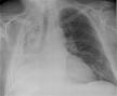 <b>Atelectasis</b>