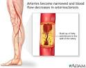 Arteriosclerosis definiiton | Health Dictionary