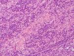 <b>Plasma cell granuloma</b>
