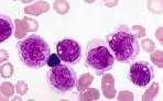 aml m5b hi1 <b>Acute</b> monocytic