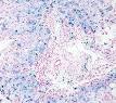 Hemosiderosis high mag.jpg
