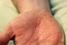 HIV Rash – Pictures, Symptoms and Treatment