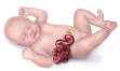 Picture of <b>Gastroschisis</b>