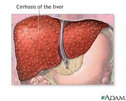 Excessive alcohol use is the leading cause of cirrhosis.