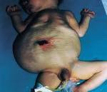 <b>prune belly syndrome</b> - meddic