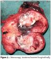 Jornal Brasileiro de Pneumologia - Mediastinal teratoma with.