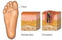 <b>Diabetic foot</b> ulcers usually