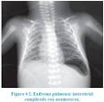 El <b>enfisema pulmonar</b>