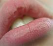 Chapped lips - Wikipedia, the free encyclopedia