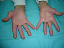 <b>ESCLERODERMIA LIMITADA</b>