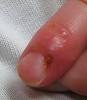 Herpes simplex - Wikipedia, the free encyclopedia
