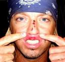 Remember during the June 2009 Tony Awards when Poison's Bret Michaels was ... - bret-michaels-bloody