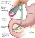 Biliary Colic Guide: Causes, Symptoms and Treatment Options
