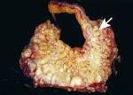 <b>renal insufficiency</b> from