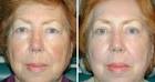 Upper and Lower Laser Eyelid